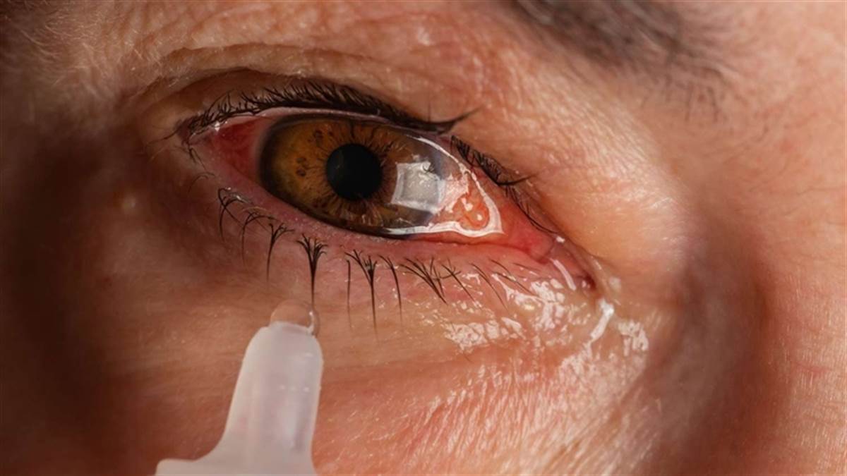 What is Eye Flu or Conjunctivitis Causes, Treatment & Prevention