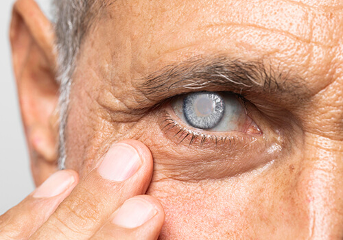 Why You Should Not Delay Scheduling Cataract Surgery